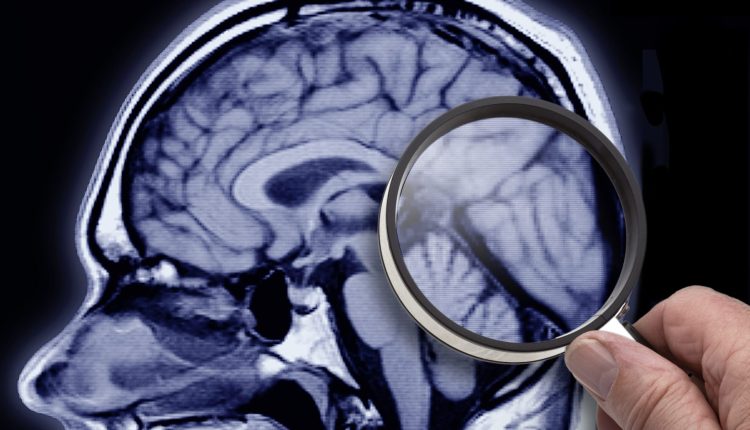Obesity associated with Azheimer-like changes in the brain

