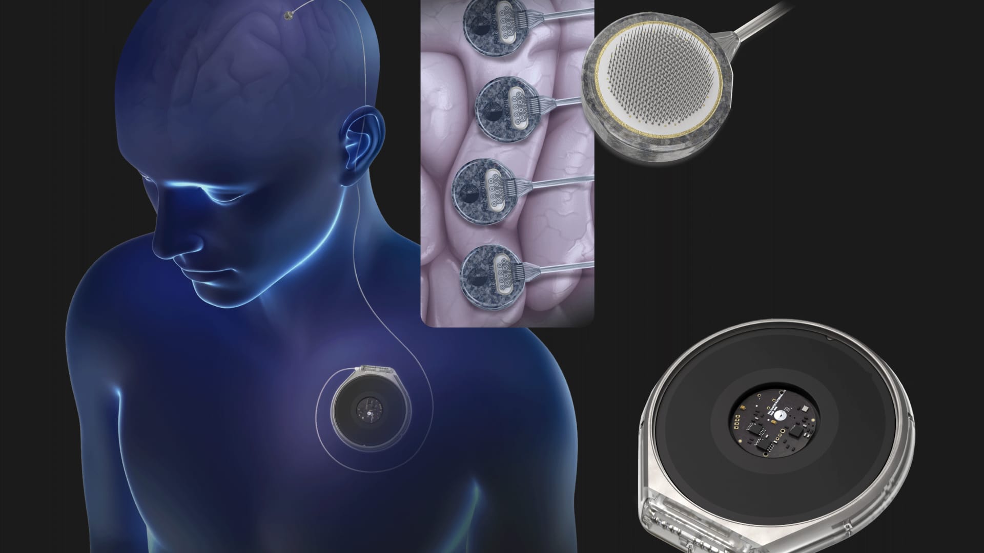 Paradromics prepares to test its brain implant on humans