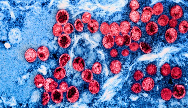 Why the recent Mpox outbreak is causing concern among health experts

